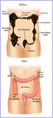 Detoxification with Colon Hydrotherapy